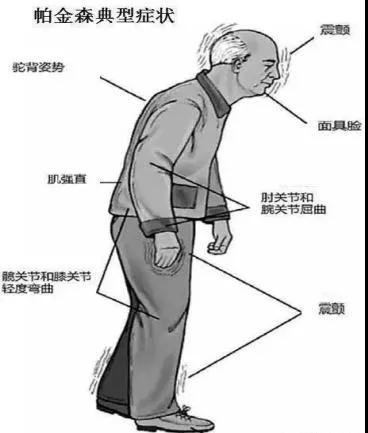 【重磅推出】陕西省康复医院帕金森门诊开诊